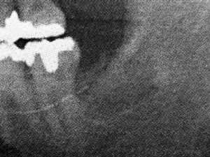 wisdom-tooth2